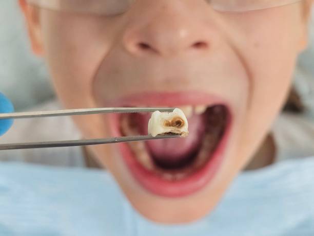 Best Cracked Tooth Emergency Dentist  in North Fork, CA