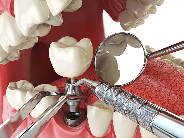 Best Chipped Tooth Repair Near Me  in North Fork, CA